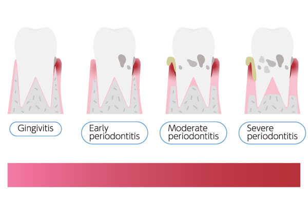 the stages of gum disease